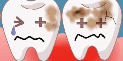 هل تسوس الأسنان معدٍّ؟ حقائق وافتراضات